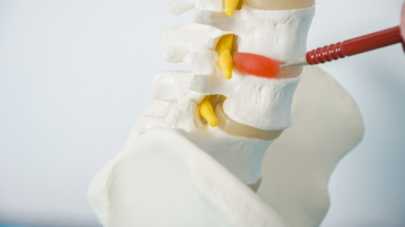 Diskbråck: orsak, symtom & behandling